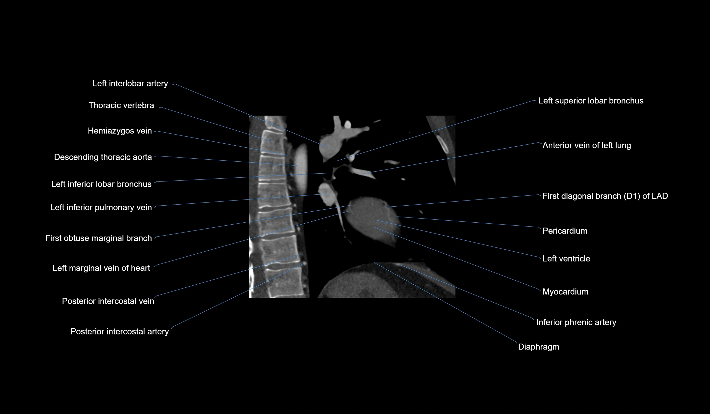 CT heart (coronary angiogram) 2 chamber view cross sectional anatomy labelled radiology image-00004.webp
